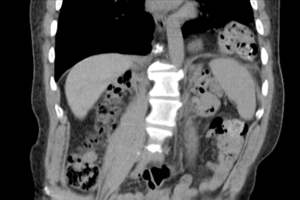 Laparoscopic Parastomal Hernia Repair Laparoscopic.MD